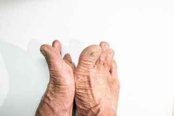 Dry and rough skin of the feet of the elderly