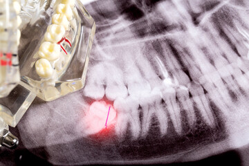 Impacted wisdom teeth on an X-ray picture with an inflamed cyst neoplasm. Removal of wisdom teeth...