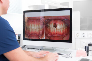 Restoration of the incisor tooth before and after treatment. The dentist looks at the result on the computer screen