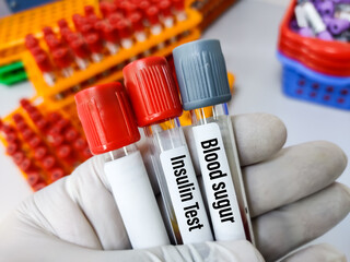 Biochemist or Lab Technologist holds Blood samples for serum insulin hormone and blood sugar test,...
