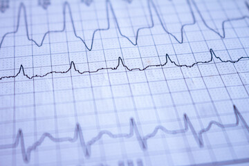 Close-up on an electrocardiogram. Heartbeat written on paper. Study of the heart.