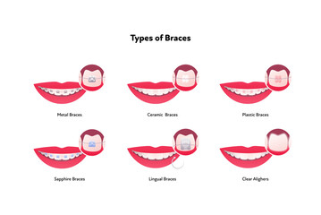 Dental teeth braces types infographic. Vector flat healthcare illustration set. Smile mouth with tooth. Different type of brace isolated on white background. - obrazy, fototapety, plakaty