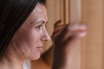 Obraz premium Close up photo of woman with dry skin looking in the window.