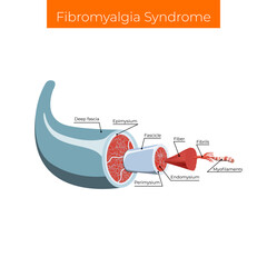Vector illustration. Fibromyalgia syndrome, widespread musculoskeletal pain accompanied by fatigue