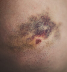 close up of skin with injury because of an accident