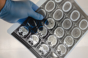 A doctor wearing a blue medical glove holds an X-ray of a person's brain. Health and Medicine....