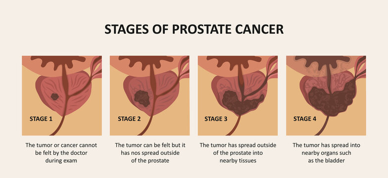 Stages of prostate cancer. The tumor grows and penetrates into organs and tissues.