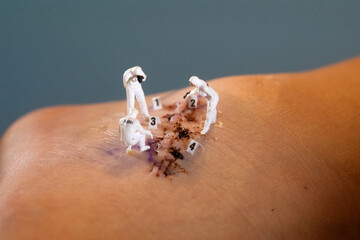 Stitches Being Handles by Miniature HO Scale Figures