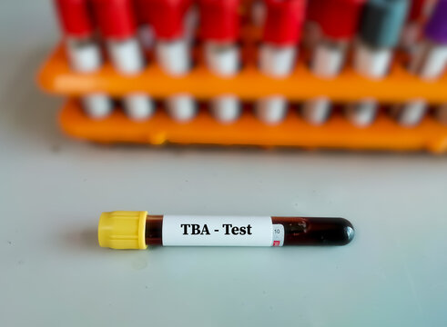 Blood sample for Total Bile Acid (TBA) test