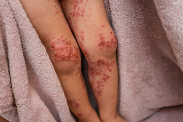 Close up enterovirus on baby body