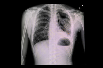 Xray chest of a patin with ICD