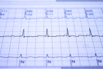 Electrocardiogram with cardiac arrhythmia. Atrial fibrillation recorded as the origin of many cerebrovascular accidents or strokes. - obrazy, fototapety, plakaty