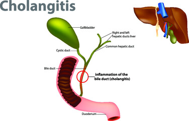 Ascending cholangitis, also known as acute cholangitis or simply cholangitis, is inflammation of the bile duct. Obstruction of the bile duct - obrazy, fototapety, plakaty
