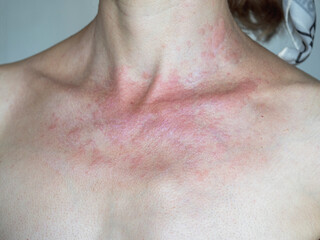 Solar dermatitis. Woman with red sunburned skin against gray background, closeup. - obrazy, fototapety, plakaty