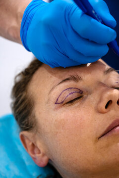 Surgeon drawing line on girl eye with marker preparing for procedure.