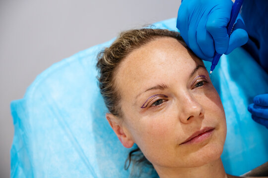 Surgeon drawing line on girl eye with marker preparing for procedure.