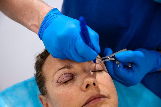 Surgeon drawing line on girl eye with marker preparing for procedure.