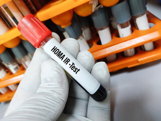 Blood sample for HOMA IR(Insulin resistance) test, early stage of type 2 diabetes,