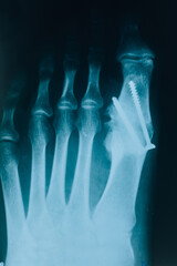 X-ray of the foot. Diseases of the leg bones. Bone pins