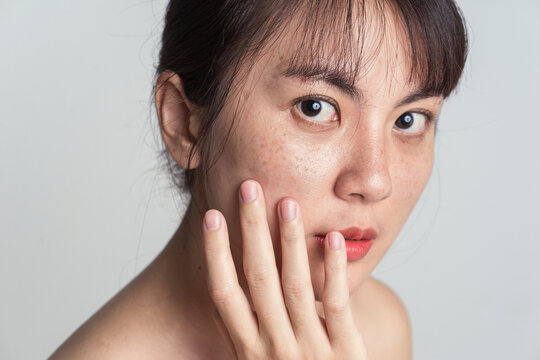 Young Asian woman worry with freckle on face.