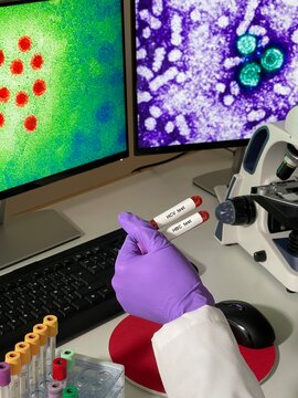 Laboratory assistant doing research with images of hepatitis a and b virus on computer.