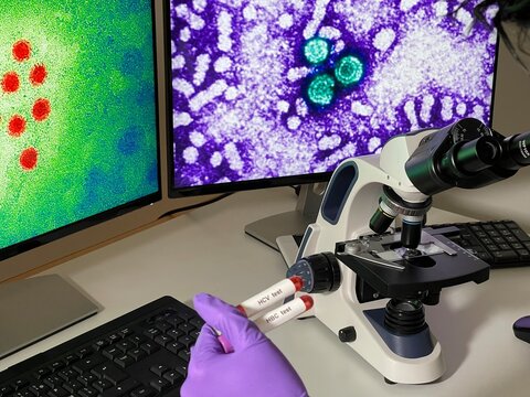 Laboratory assistant doing research with images of hepatitis a and b virus on computer.
