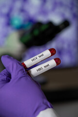 Blood tests for hepatitis b (HBC) and c (HCV).