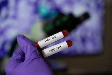 Obraz premium Blood tests for hepatitis b (HBC) and c (HCV).
