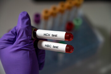 Obraz premium Blood tests for hepatitis b (HBC) and c (HCV).