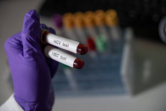 Blood Tests For Hepatitis B (HBC) And C (HCV).