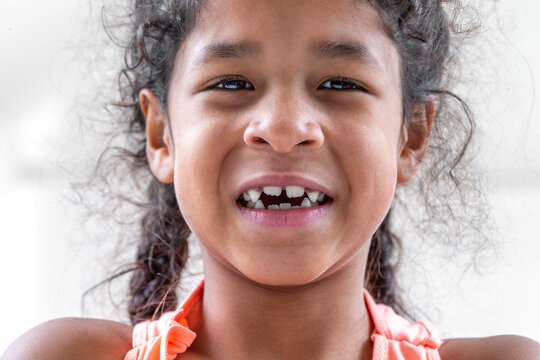 Close up girl mouth with crooked broken teeth and odontolith, will need a dental appliance.