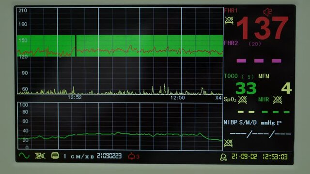 Electronic Cardiotocography Machine Monitoring Fetal Heart Contractions Of Uterus. Printing Cardiogram Report Coming Out Electrocardiogram In Labor Ward During Pregnancy. Medical Diagnostic Equipment