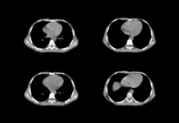 Ct scan and MRI chest unique professional images