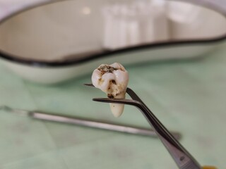 Extracted wisdom tooth in tweezers