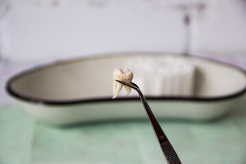 Extracted tooth in tweezers at the dentist's office