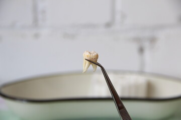 Extracted tooth in a tweezers