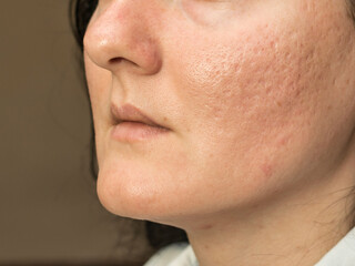 Woman with problematic skin and acne scars. Pigmentation on face woman. 