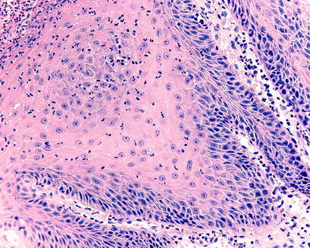 Soft Palate Papilloma