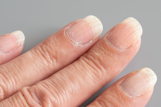 Ongles stri&eacute;s, ab&icirc;m&eacute;s, dess&eacute;ch&eacute;s
Main de femme en gros plan