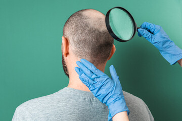 Trichologist examines the area of baldness on the client's head with a magnifying glass. Back view....