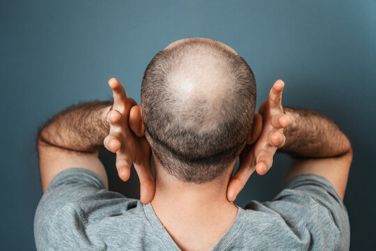 Baldy man suffering because of his appearance. Person grabs his head with his hands. Back view. Turquoise background. The concept of alopecia and baldness