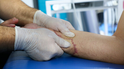 Suture wound on hand from dermatology procedure. Wound physical therapy - obrazy, fototapety, plakaty