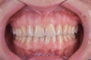 Tooth In-oral Photo