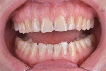 close up of mouth with braces
