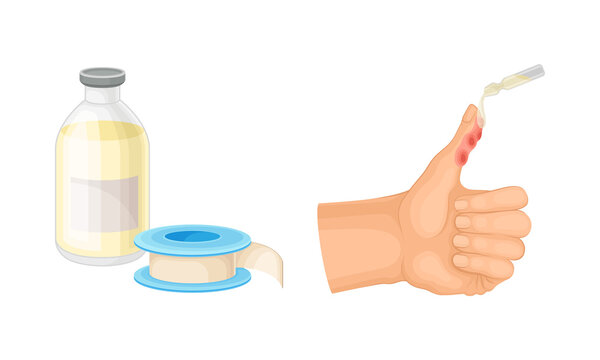 Skin burn injury treatment. First aid for thermal wound. Damaged finger and ointment vector illustration