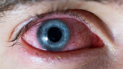 Obraz premium Close up of blue eye with many capillaries. Eyesight problems. Health care.