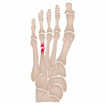 Fracture of the metatarsal bones in the foot. Anatomical structure of the foot. Skeleton. Broken bones. Vector illustration on isolated background