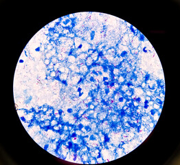Pulmonary Tuberculosis ( TB ) : Sputum AFB stain microscopic image. To diagnosis mycobacterium...