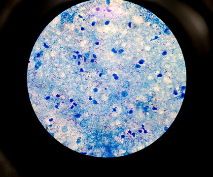 Pulmonary Tuberculosis ( TB ) : Sputum AFB stain microscopic image. To diagnosis mycobacterium tuberculosis infection. MTB mycobacterium tuberculosis  3+