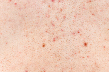 Skin background texture with pimples and blackheads. problematic skin close up. acne diseases